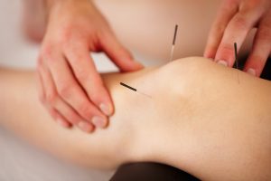 Dry needling in rehab - debunking common misconceptions