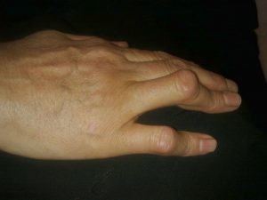 Boutonniere deformity diagnosis example